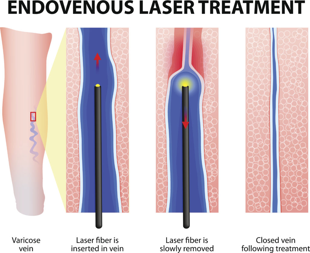 laser varicose vein surgery